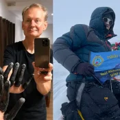 Teške promrzline